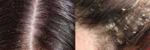Как избавиться от сухой перхоти – 15 шампуней на волосы, причины и лечение