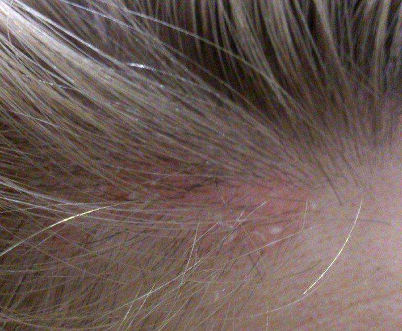 Лечение себорейного дерматита на волосистой части головы