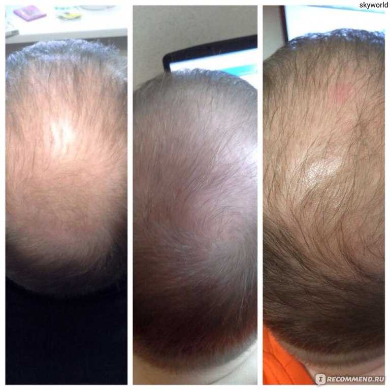 Средство от выпадения волос эсвицин, виофарм — отзывы