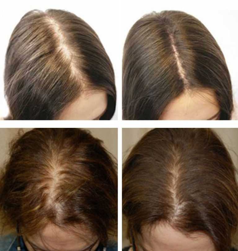 Особенности мезотерапии для волос