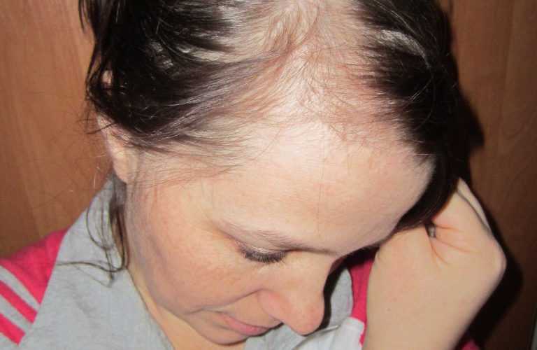 Что делать если выпадают волосы у молодой мамы при грудном вскармливании