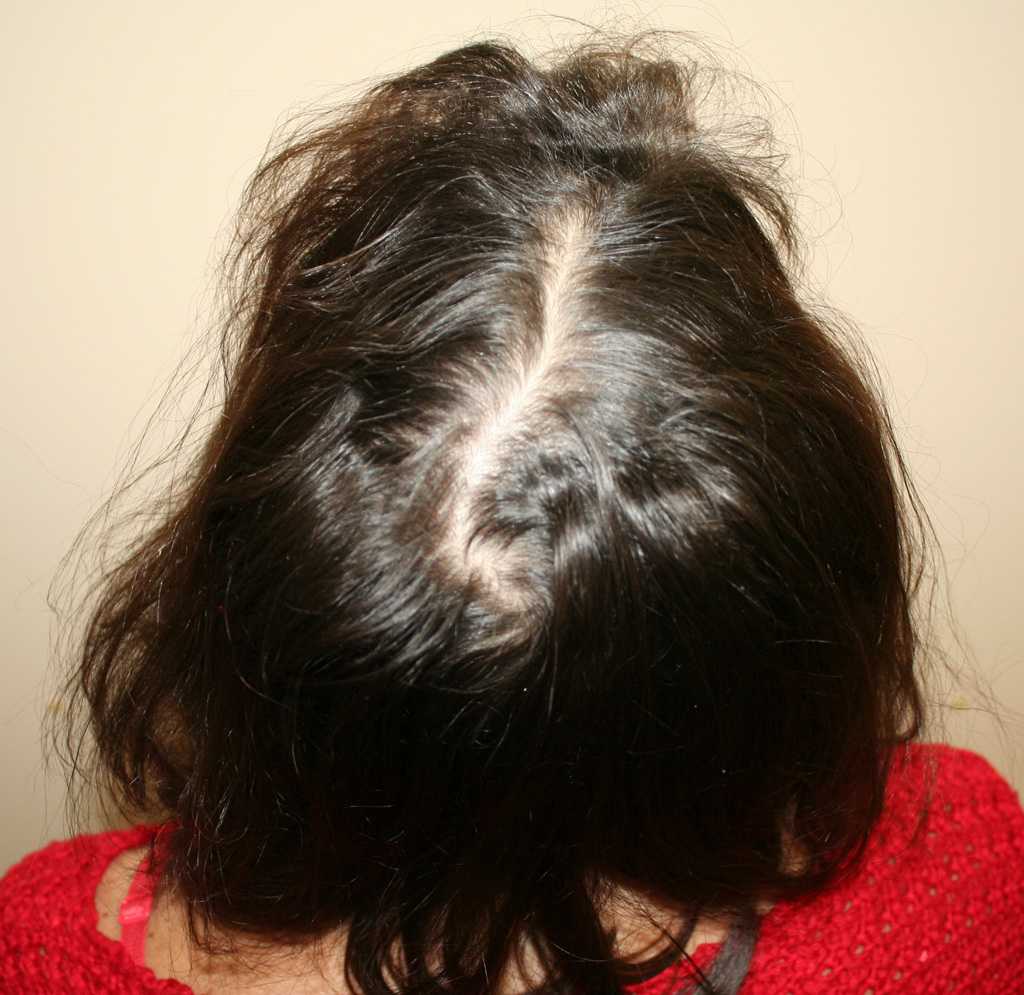 Сильное выпадение волос у женщин: причины и лечение