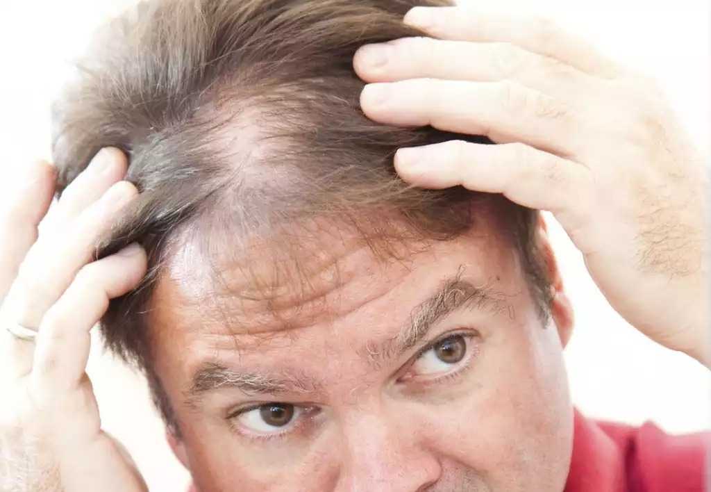 Причины очагового выпадения волос у мужчин и женщин, методы лечения заболевания