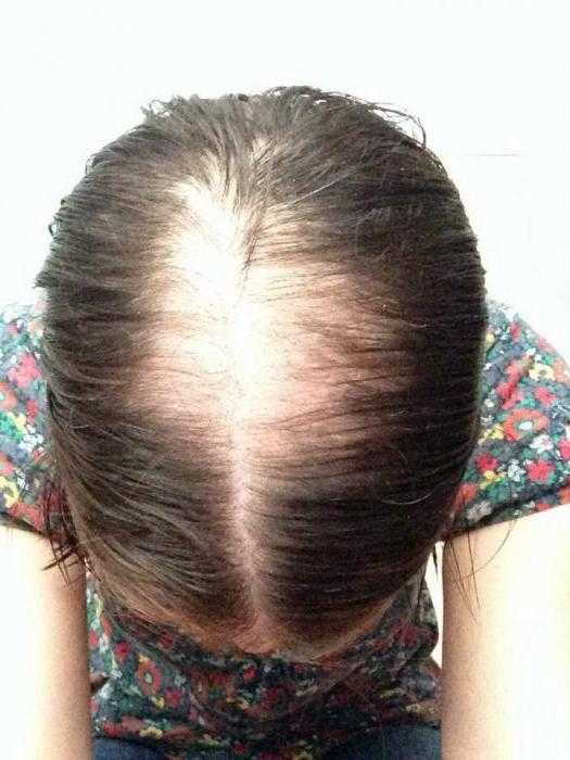 Могут ли выпадать волосы после лучевой терапии