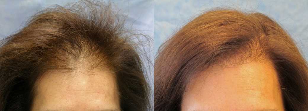 12 способов восстановить густоту волос
