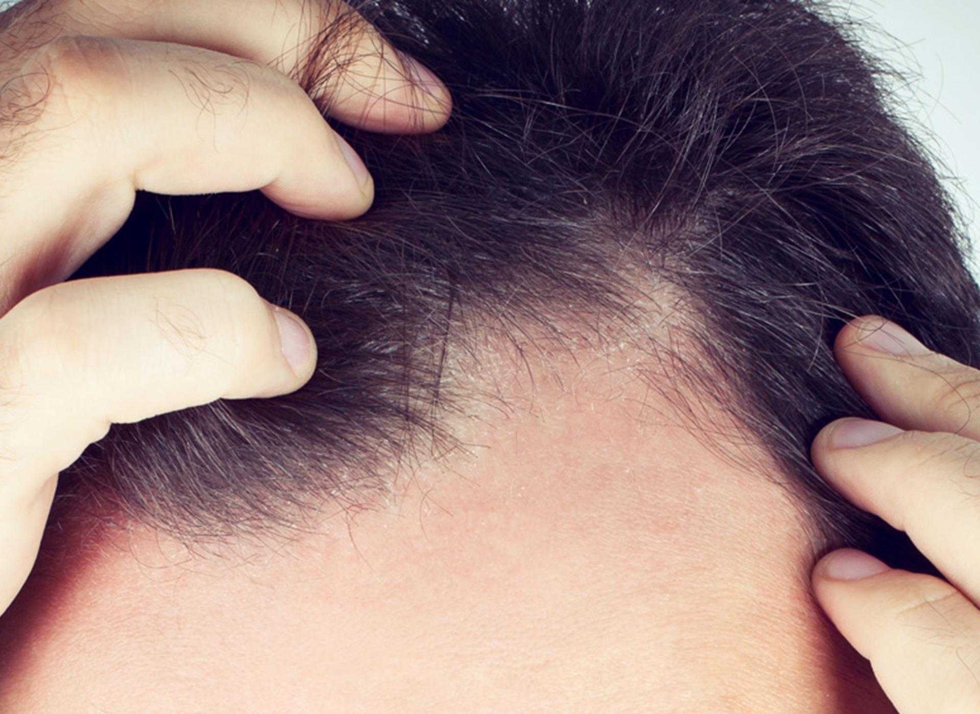 Жирная кожа головы и выпадение волос у мужчин как лечить