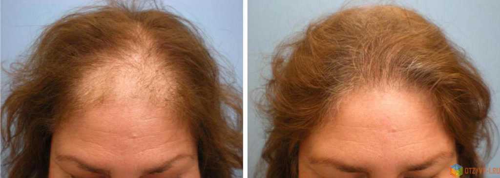 Миноксидил для роста волос – описание, цена, показания, противопоказания