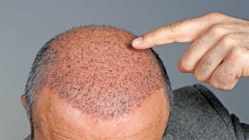Топ-10 медицинских средств от выпадения волос у мужчин