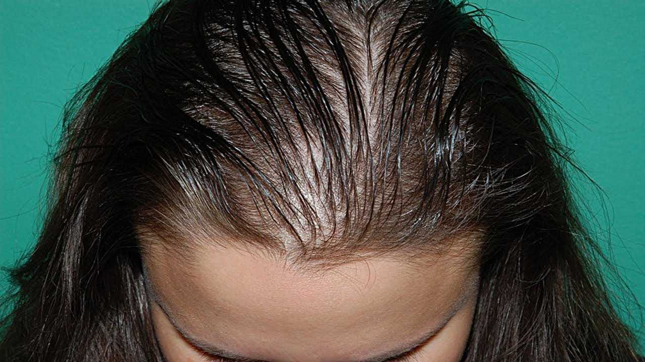 Могут ли выпадать волосы у женщин из за тестостерона