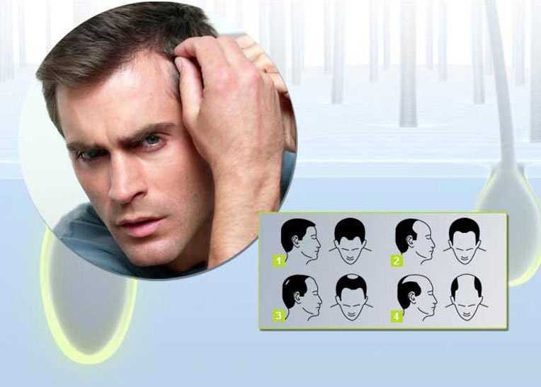 Дигидротестостерон и выпадение волос