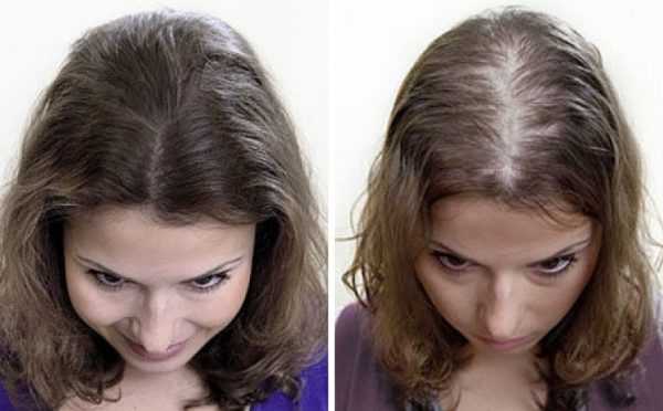 Диагностика и лечение диффузной алопеции: как сохранить волосы