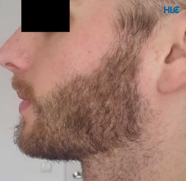 С какого возраста начинает расти борода?