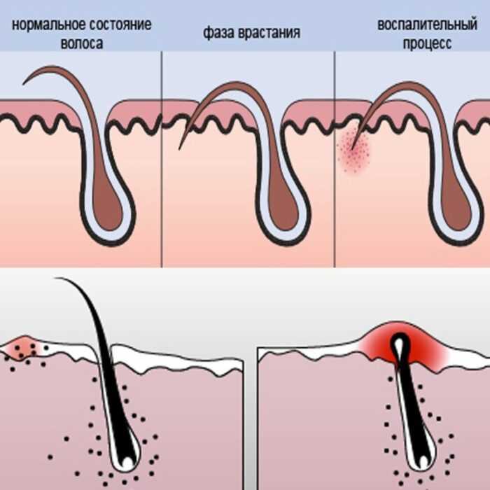 Причины появления и способы избавления от вросших волос на лобковой части