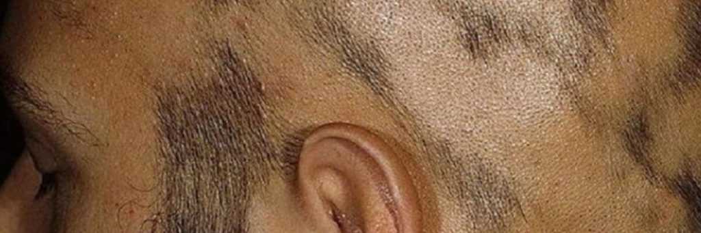 Особенности и симптомы алопеции на бороде у мужчин. причины появления проплешин на подбородке. лечение облысения бороды: аптечные средства, народные способы. профилактика.