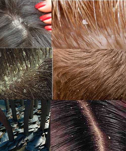 Как избавиться от сухой перхоти – 15 шампуней на волосы, причины и лечение