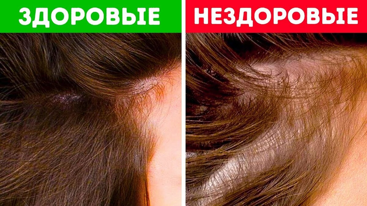 Выпадение волос: норма в день, иначе заболевание