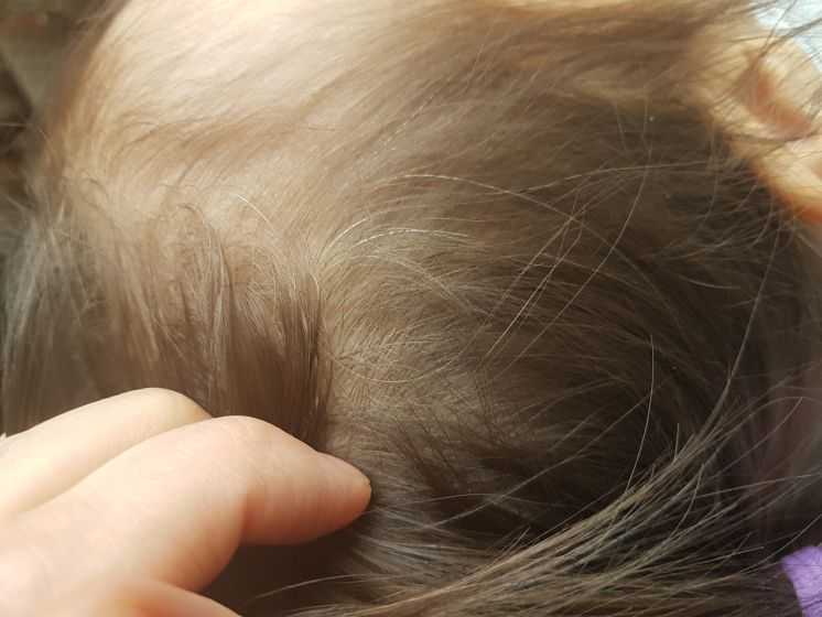 Как вылечить седые волосы у ребенка