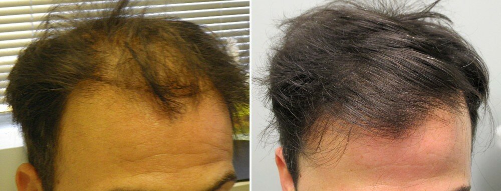 Эффективные средства от выпадения волос у мужчин