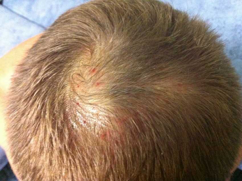 Причины прыщиков в волосистой части головы у взрослых