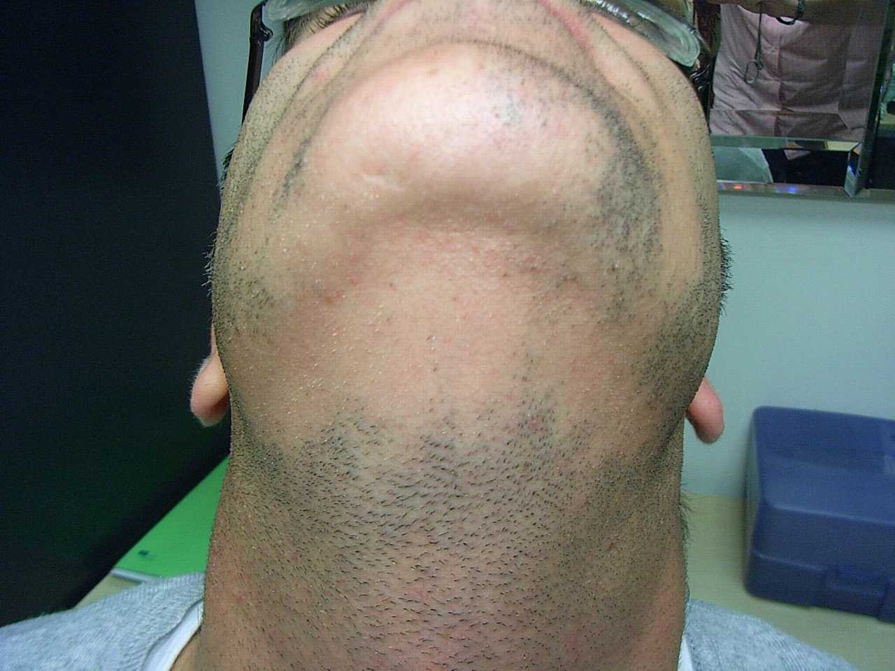 Алопеция на бороде у мужчин лечение