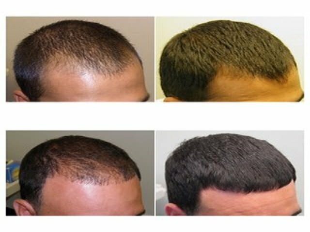 Средства от выпадения волос: самые лучшие и эффективные препараты от облысения