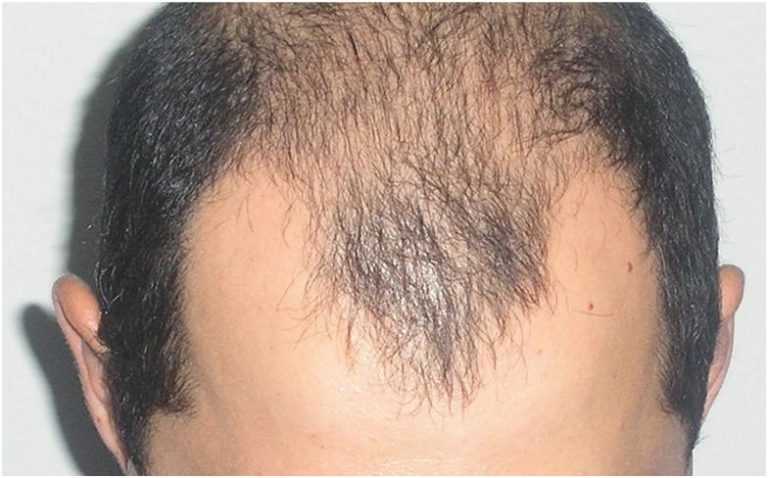 Алопеция на бороде у мужчин причины возникновения и методы лечения