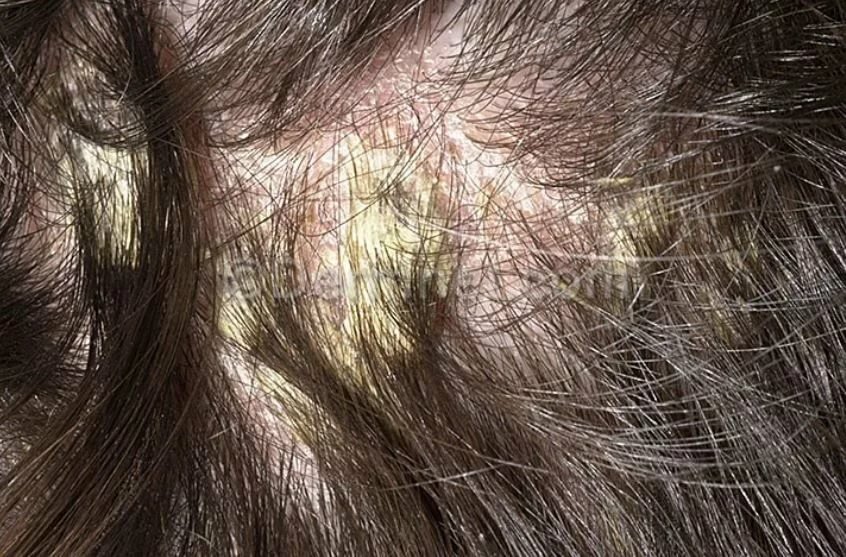 Себорейный дерматит волосистой части головы: лечение медикаментозное и народными методами, фото симптомов себореи на голове и причины возникновения