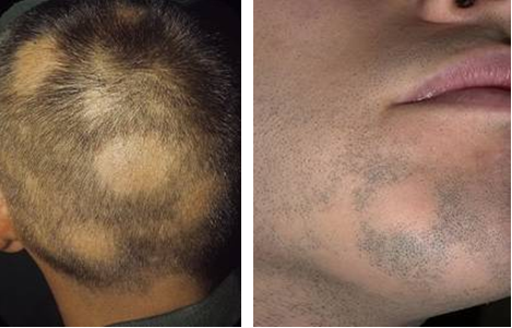 Алопеция на бороде у мужчин лечение народными средствами