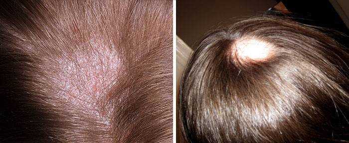 Эффективные методы борьбы с раздражением кожи головы и причины появления этой проблемы