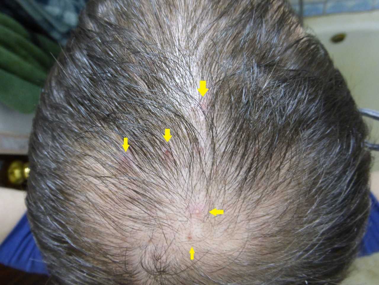 Причины возникновения и лечение прыщей на волосистой части головы у мужчин