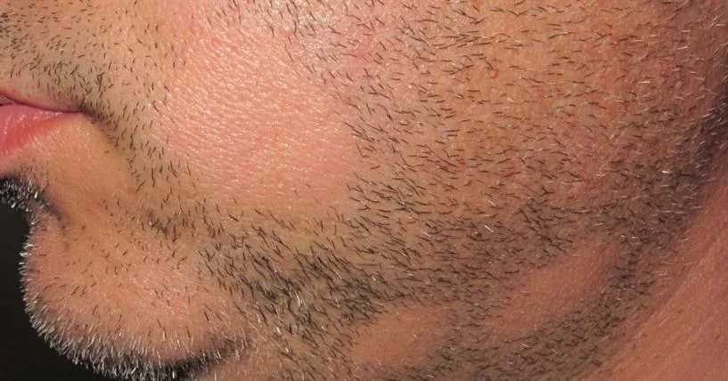 Алопеция у мужчин на бороде: причины, диагностика, лечение