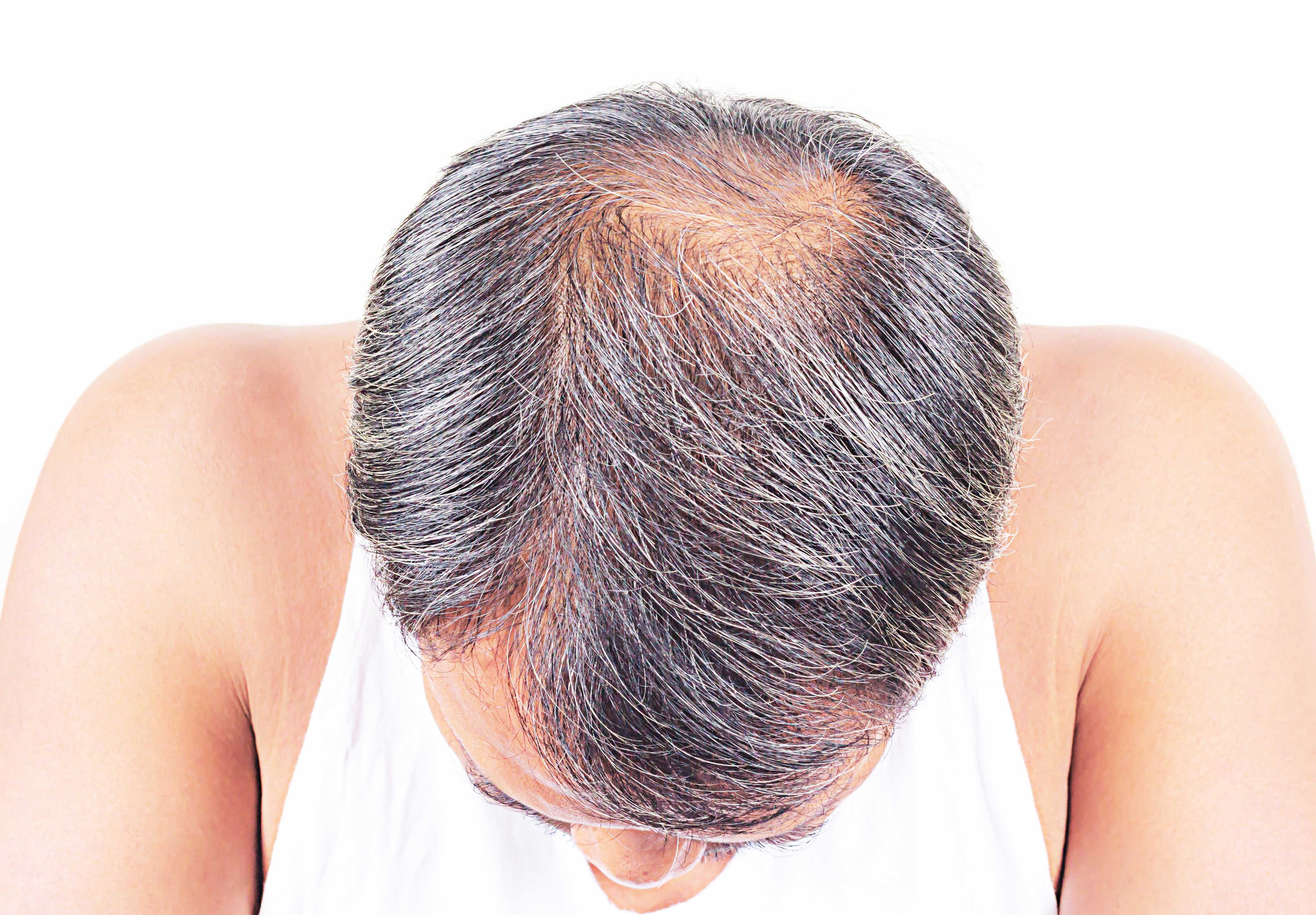 Остановить выпадение волос у женщин: как быстро предотвратить