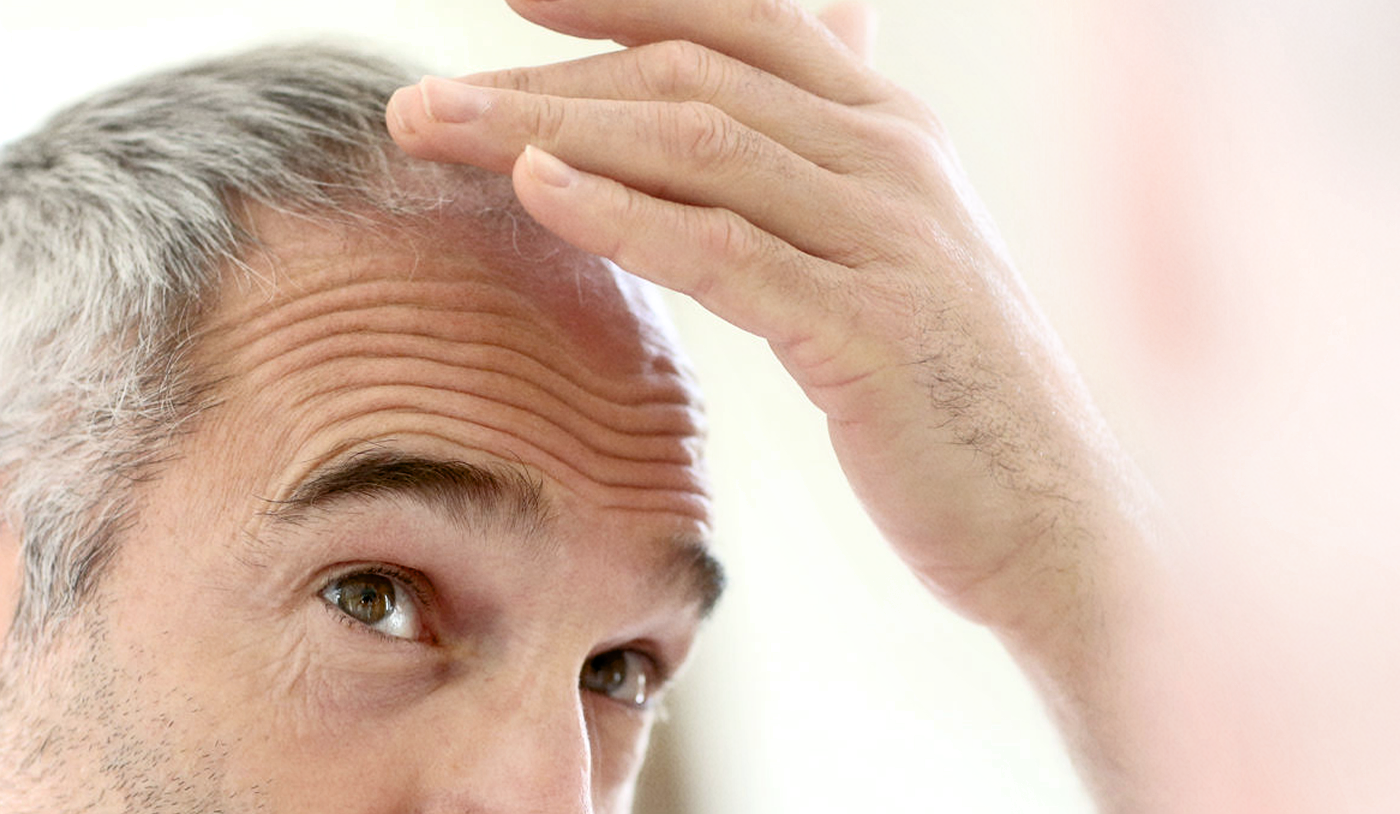 Почему у мужчин в молодом возрасте выпадают волосы и как это остановить?