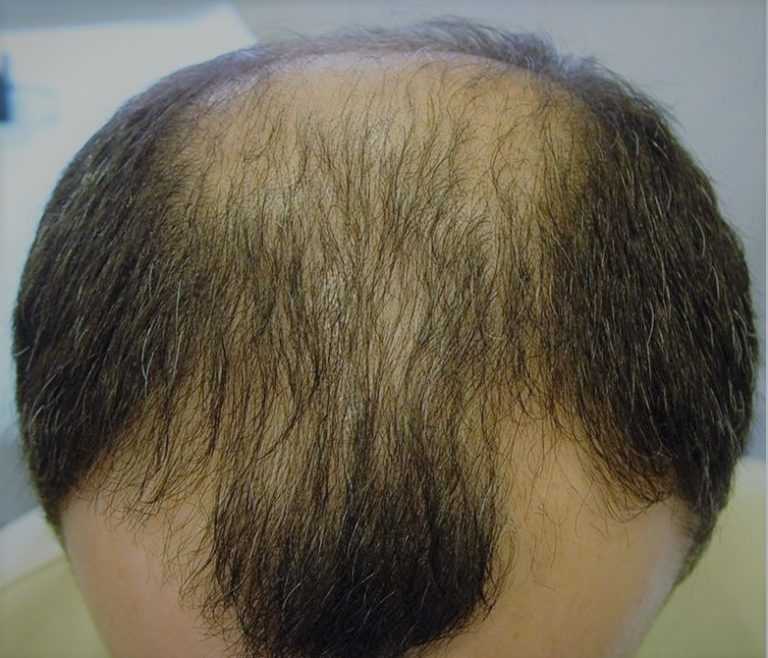 Методы и средства восстановления волос после выпадения: оценка эффективности