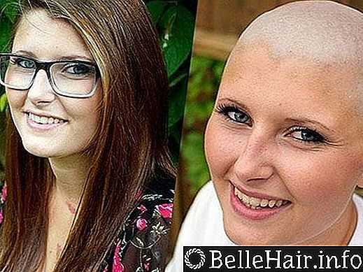 Выпадение волос после химиотерапии