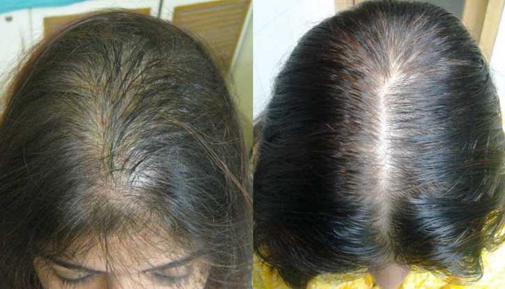 Как предотвратить выпадение волос при грудном вскармливании