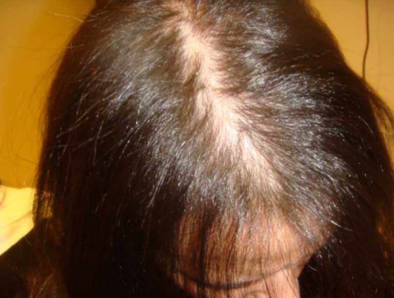 Диффузная алопеция (телогеновое выпадение волос): что это такое, лечение у женщин и мужчин, фото, отзывы, витамины от облысения негормональной этиологии