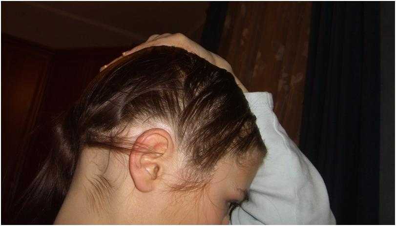 Очаговая алопеция у женщин – что это такое и как лечить выпадение волос