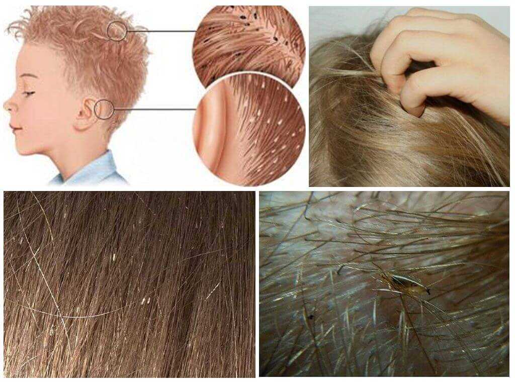 Симптомы вшей - признаки педикулеза на голове у взрослых и детей