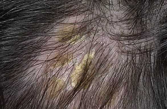 Как лечить себорейный дерматит волосистой части головы у взрослых и детей?