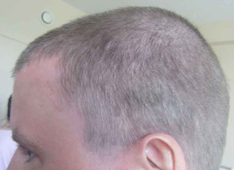 Шампунь от псориаза на голове: чем мыть волосистую часть головы, отзывы, псорилом, этривекс и другие эффективные средства, цена, инструкция по применению