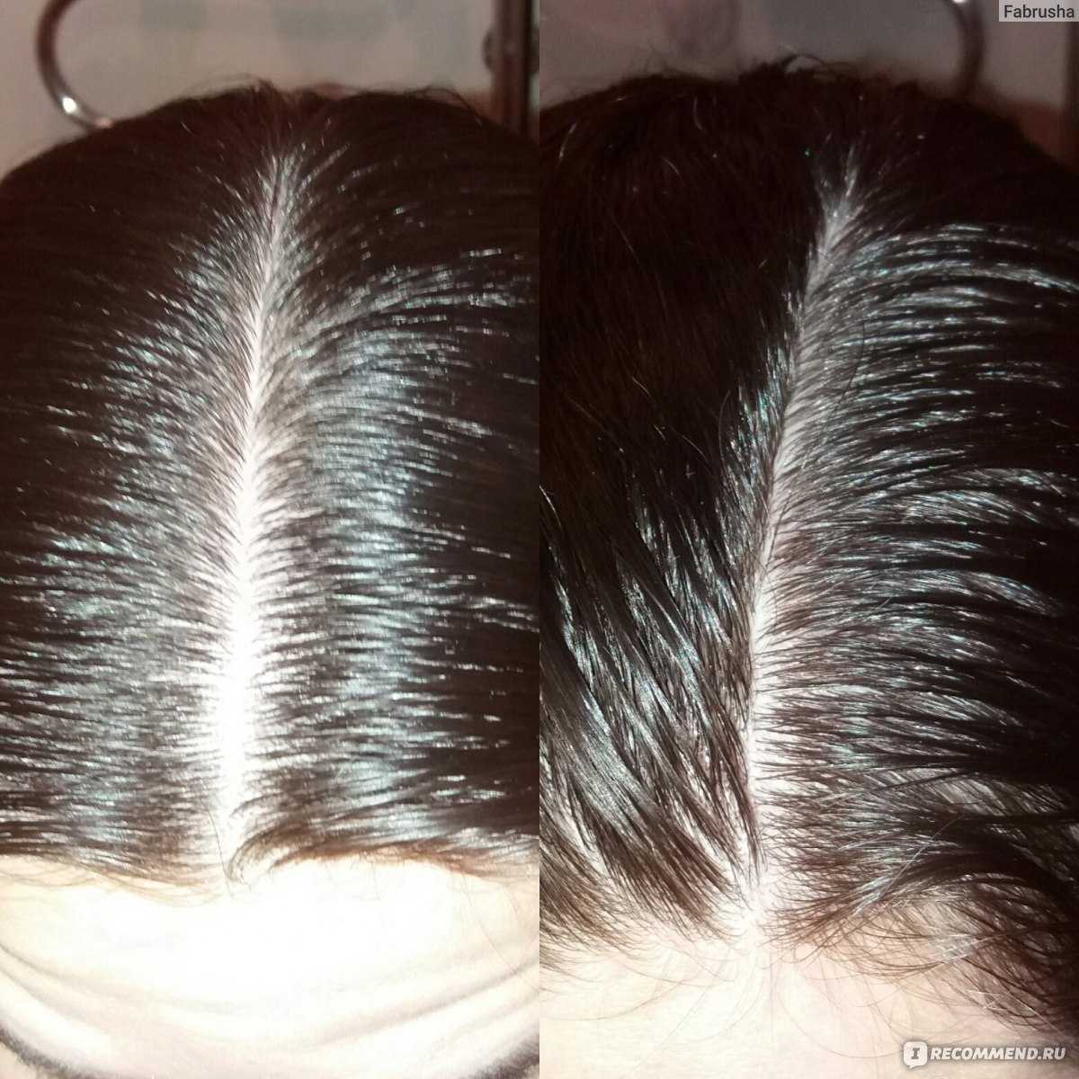Восстановление густоты волос в москве