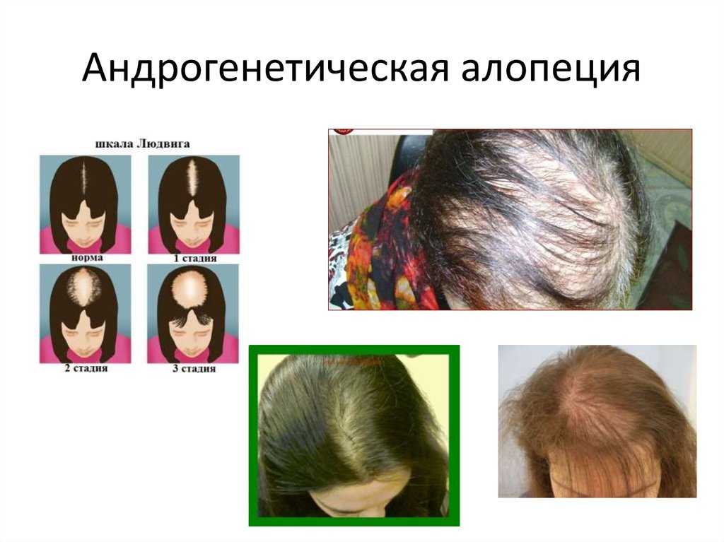 Причины, симптомы, стадии гнездной алопеции у женщин, и как можно остановить выпадение волос
