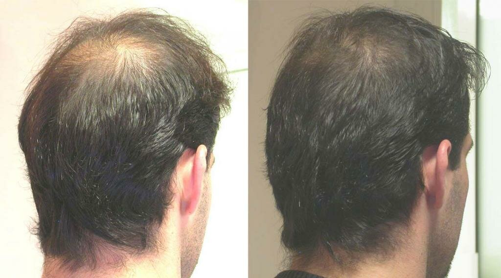 Методы и средства восстановления волос после выпадения: оценка эффективности