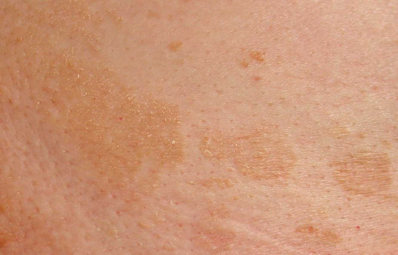 Грибковая инфекция кожи