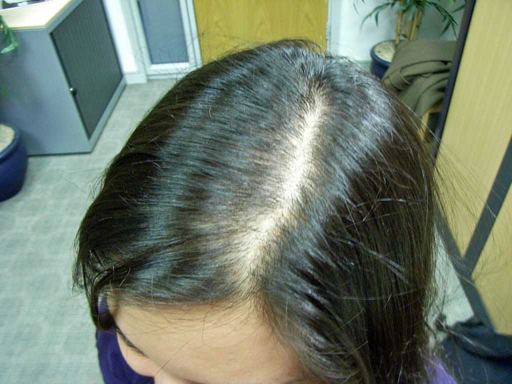 Алопеция у женщин: причины выпадения волос, лечение облысения