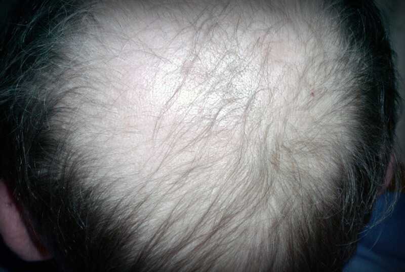 Зуд выпадение волос причины. Асбестовидный себорейный дерматит. Себорейный дерматит алопеция. Себорейное облысение (алопеция). Фолликулярная себорея.