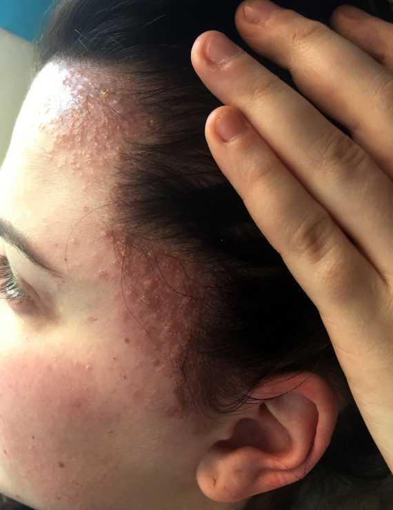 Аллергия на средства для укладки волос