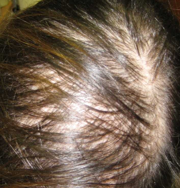 После окрашивания начали выпадать волосы. что делать, если после окрашивания сильно выпадают волосы