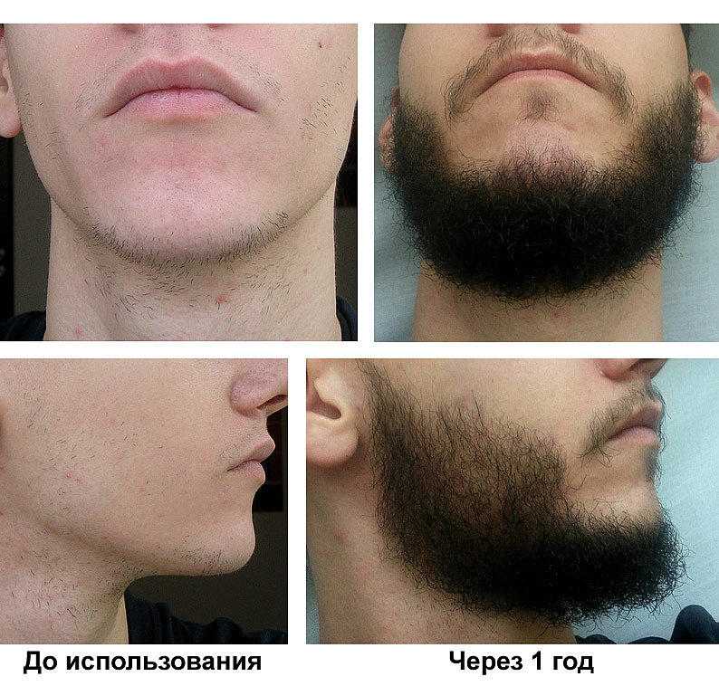 Как отрастить бороду в 17 лет?